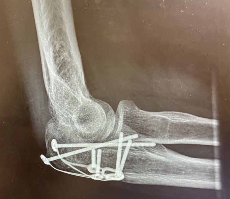 x-ray with 2 plates & 6 screws